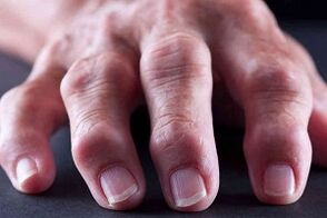 Las principales diferencias de artritis y artrosis
