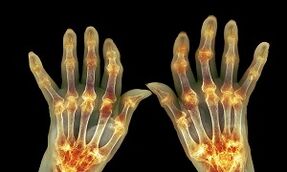 ¿Cuál es la diferencia entre la artritis de la artrosis de las articulaciones