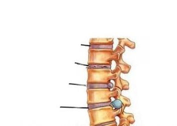 Cuatro etapas de desarrollo de la osteocondrosis
